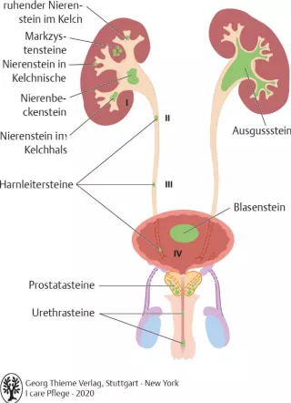 Bild: I care Krankheitslehre | Spezielle Krankheitslehre | Lokalisation von Harnsteinen (Grafik)