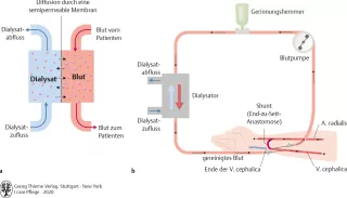 Bild: I care Krankheitslehre | Spezielle Krankheitslehre | Hämodialyse (Grafik)