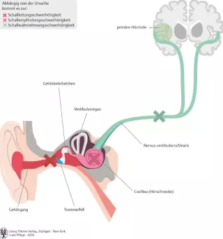 Bild: I care Krankheitslehre | Spezielle Krankheitslehre | Formen der Schwerhörigkeit (Grafik)