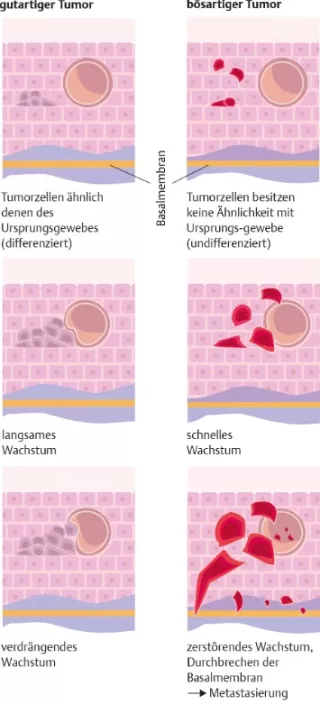 Bild: I care Krankheitslehre | Grundlagen | Gutartiger und bösartiger Tumor (Grafik)