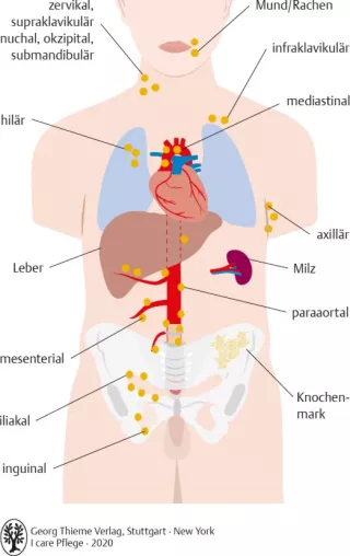 Bild: I care Krankheitslehre | Spezielle Krankheitslehre | Lokalisation der Lymphknotenschwellungen bei malignen Lymphomen (Grafik)