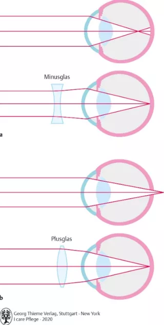 Bild: I care Krankheitslehre | Spezielle Krankheitslehre | Fehlsichtigkeit (Grafik)