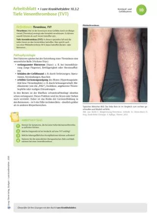 Arbeitsblatt: I care Krankheitslehre | Spezielle Krankheitslehre | Tiefe Venenthrombose (Arbeitsblatt)