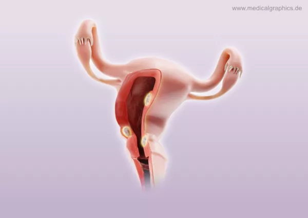 Bild: Myome Uterus (unten)