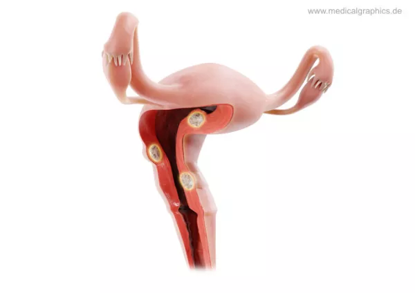 Bild: Myome Uterus (seitlich)