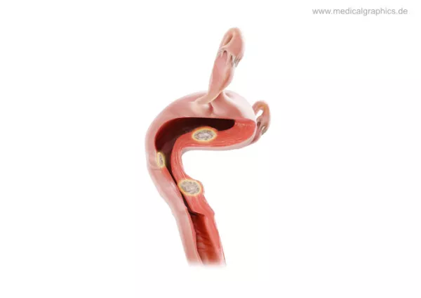 Bild: Myome Uterus (recht)