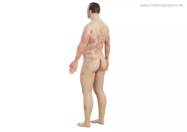 Bild: Mensch Psoriasis (seitlich-hinten)
