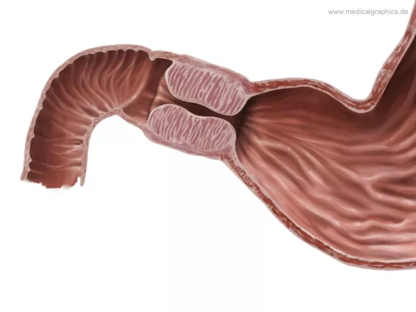 Bild: Pylorusstenose