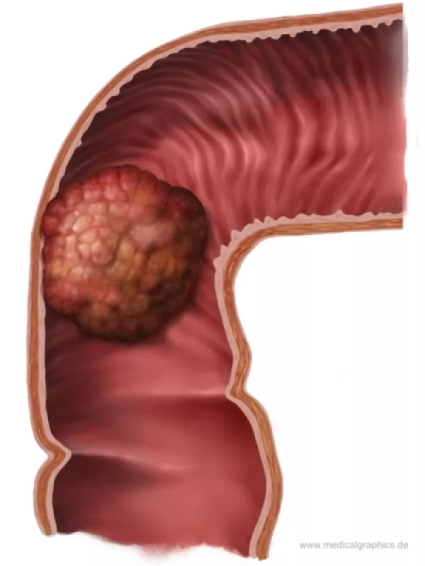 Bild: Polypöses Adenokarzinom – Rektum