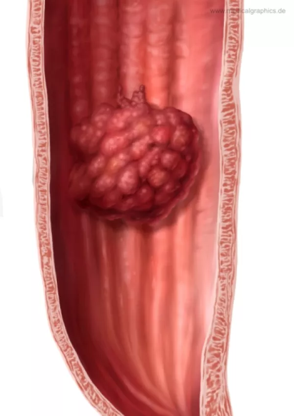 Bild: Ösophaguskarzinom (exophytisch)