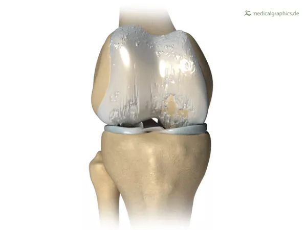Bild: Knie mit Arthrose (behandelt)