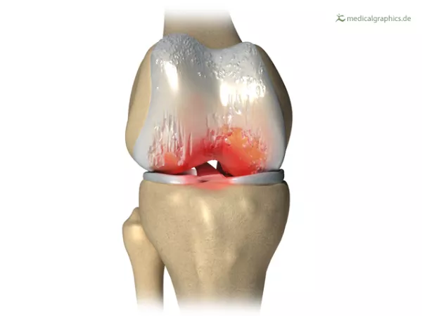 Bild: Knie mit Arthrose