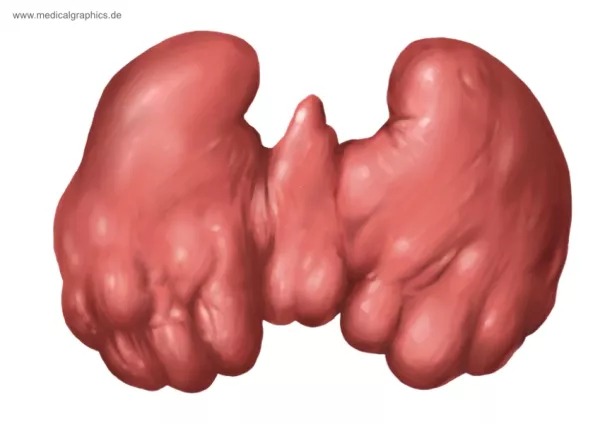 Bild: Hashimoto-Thyreoiditis