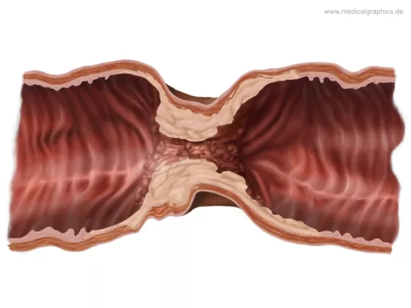 Bild: Einschnürendes Adenokarzinom Colon Transversum