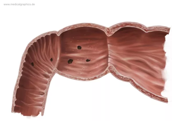 Bild: Duodenitis