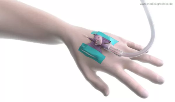Bild: Intravenöser Zugang am Handrücken