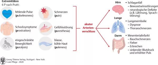 Bild: I care Pflege | Pflege bei speziellen Erkrankungen | Akuter Arterienverschluss (Grafik)
