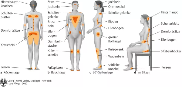 Bild: I care Pflege | Pflegebasismaßnahmen | Prädilektionsstellen für einen Dekubitus (Grafik)