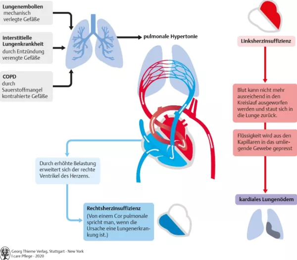 Bild: I care Pflege | Pflege bei speziellen Erkrankungen | Pulmonale Hypertonie (Grafik)