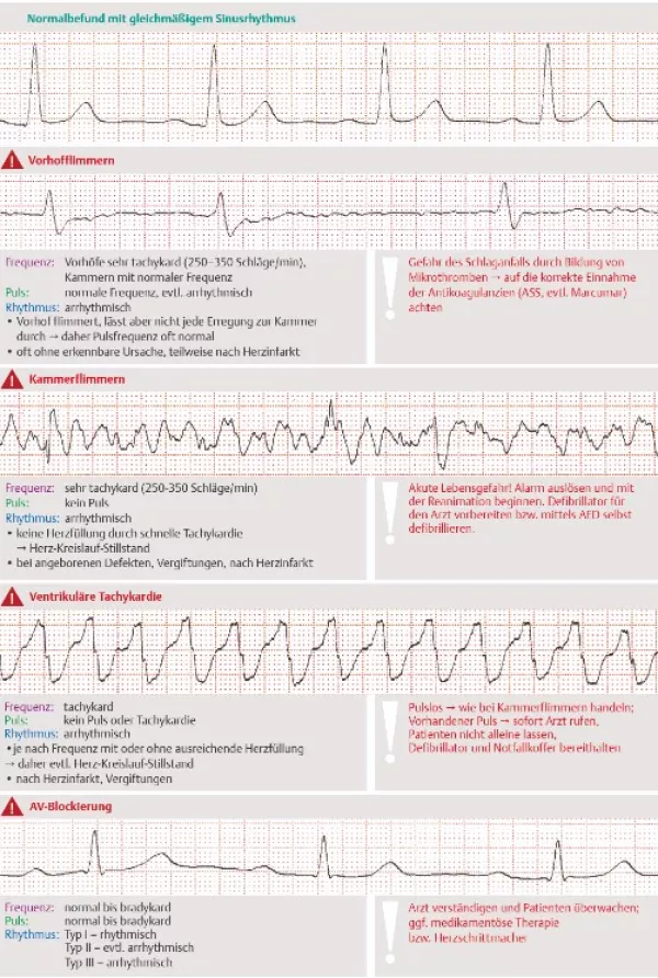 Bild: I care Pflege | Pflege bei speziellen Erkrankungen | Herzrhythmusstörungen (Grafik)