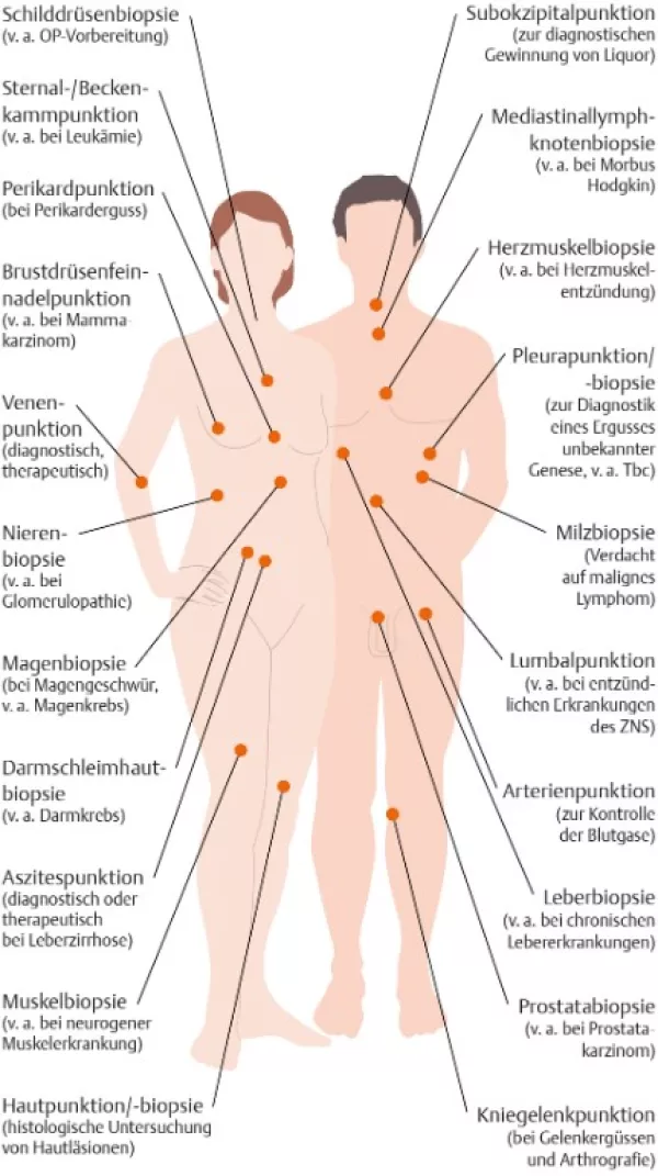 Bild: I care Pflege | Pflegetechniken | Häufige Stellen für Punktionen und Biopsien (Grafik)