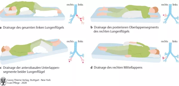 Bild: I care Pflege | Pflege bei speziellen Erkrankungen | Drainagelagerung (Grafik)
