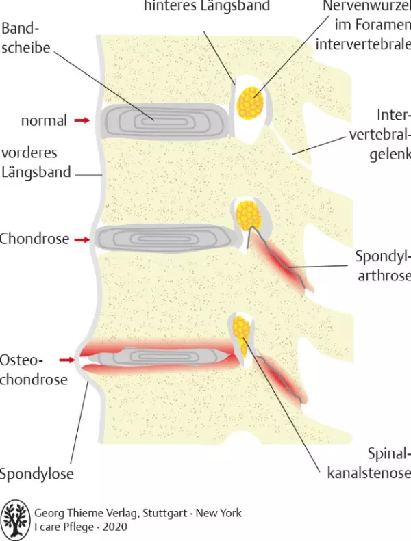 Bild: I care Pflege | Pflege bei speziellen Erkrankungen | Degenerative Wirbelsäulenerkrankungen (Grafik)