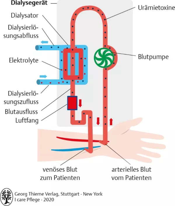 Bild: I care Pflege | Pflege bei speziellen Erkrankungen | Hämodialyse (Grafik)