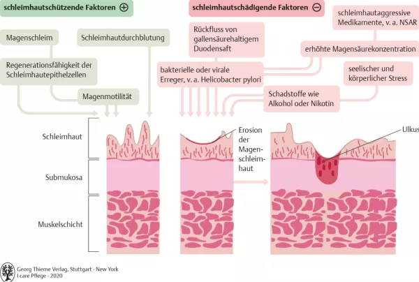 Bild: I care Pflege | Pflege bei speziellen Erkrankungen | Gastritis (Grafik)