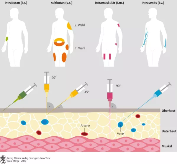Bild: I care Pflege | Pflegetechniken | Injektionsarten und deren Injektionsbereiche, Injektionstiefen und Injektionswinkel (Grafik)