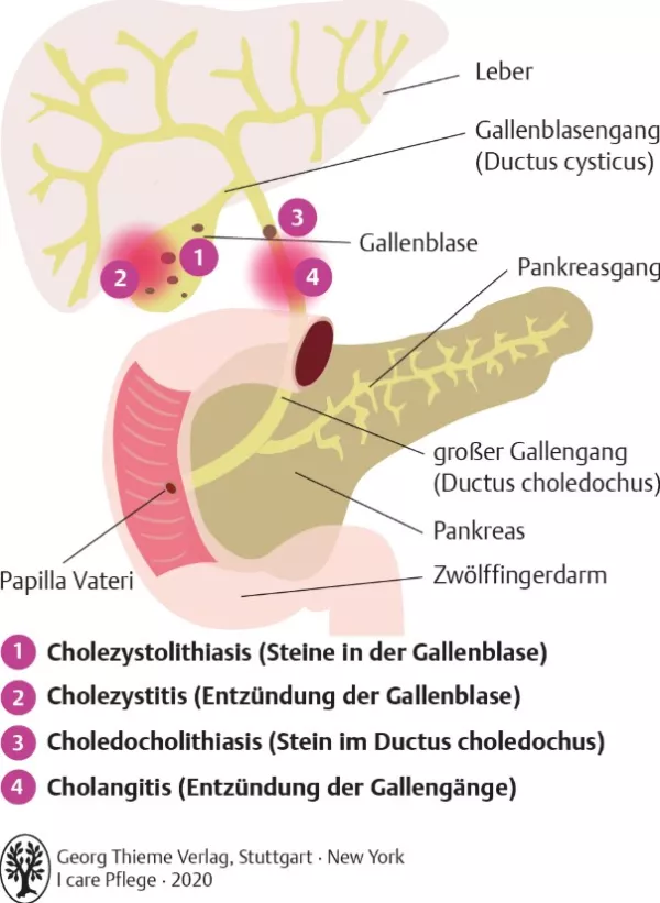 Bild: I care Krankheitslehre | Spezielle Krankheitslehre | Cholelithiasis (Grafik)