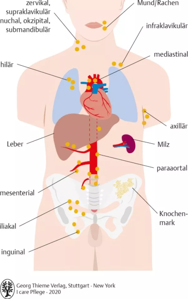 Bild: I care Krankheitslehre | Spezielle Krankheitslehre | Lokalisation der Lymphknotenschwellungen bei malignen Lymphomen (Grafik)