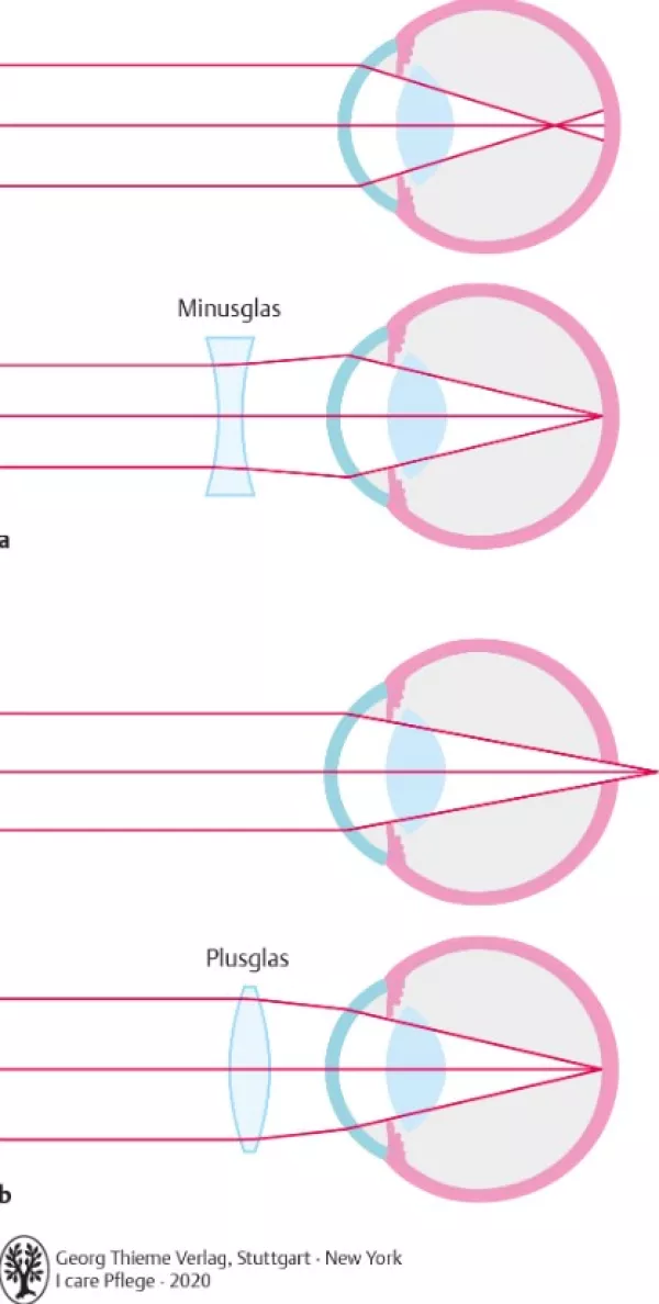 Bild: I care Krankheitslehre | Spezielle Krankheitslehre | Fehlsichtigkeit (Grafik)
